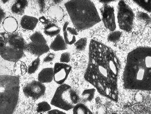 M,58y. | crystalline inclusions in hepatocyte after unknown medication